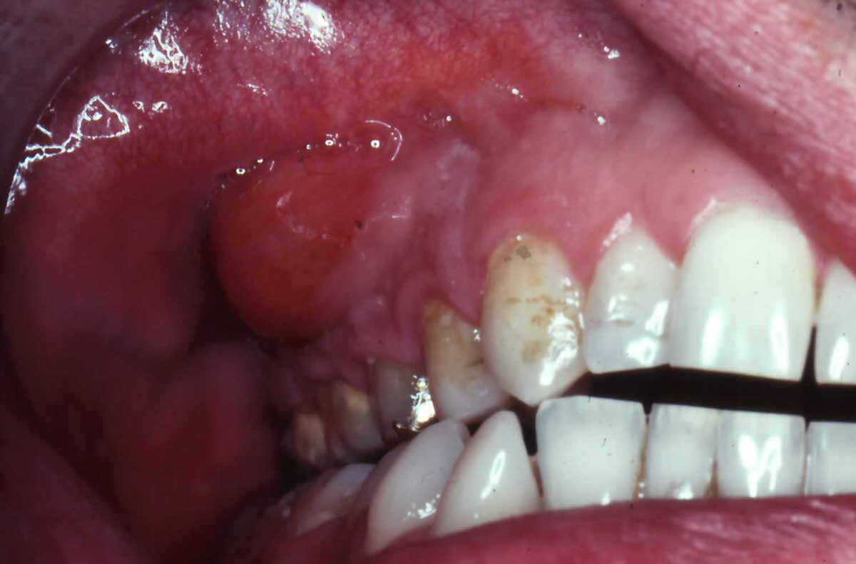 شناسایی علائم آبسه دندان