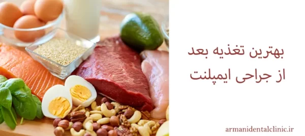 بهترین تغذیه بعد از جراحی ایمپلنت