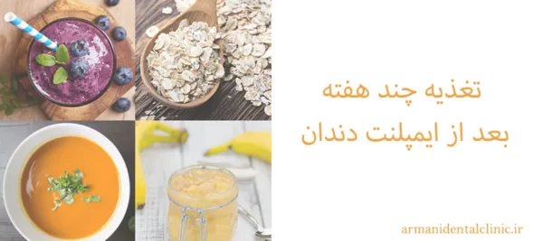 تغذیه چند هفته بعد از ایمپلنت دندان