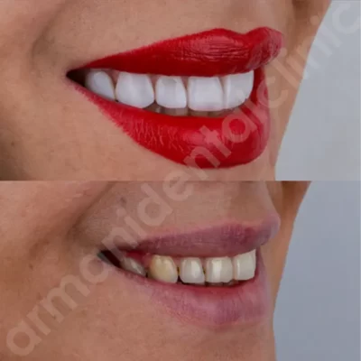 عکس قبل و بعد ونیر دندان در کلینیک آرمانی 