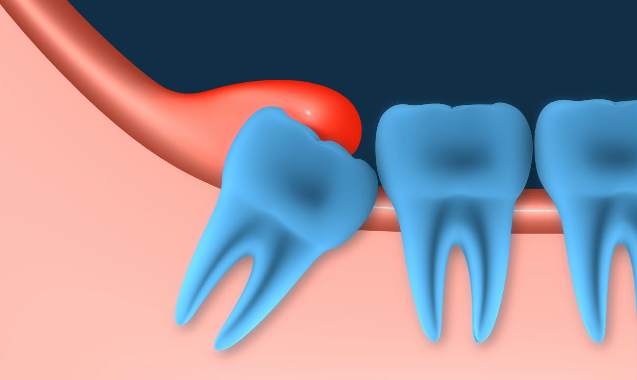 hood in the wisdom tooth and its complications