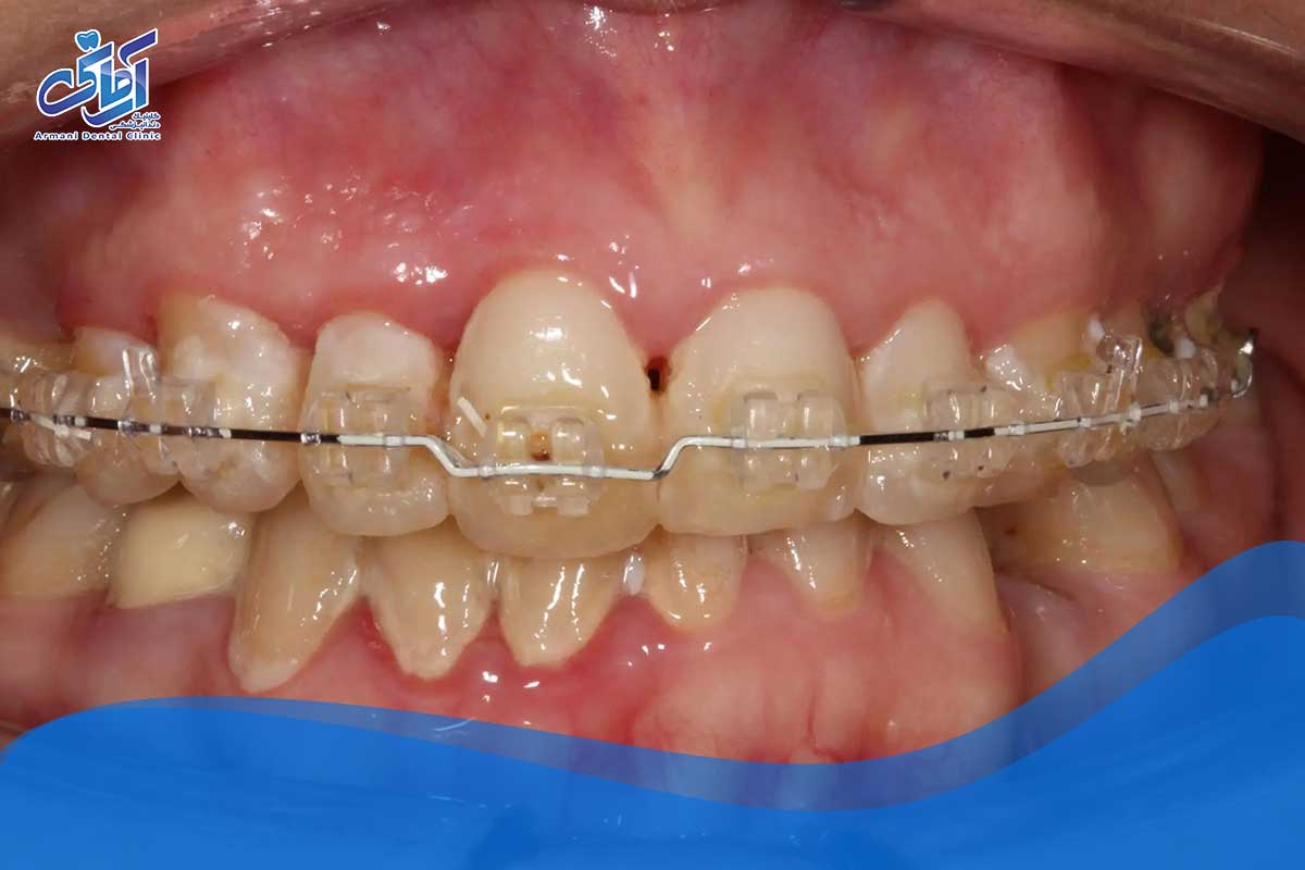 سیم دندان فلزی