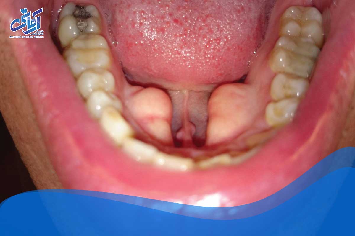 رشد استخوان در دهان