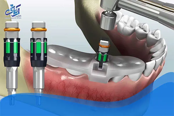 ایمپلنت دیجیتال