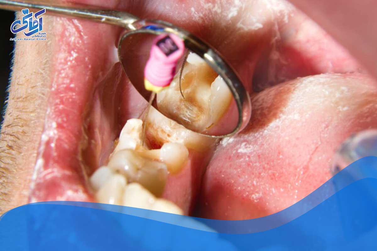 دلیل پالپوتومی دندان