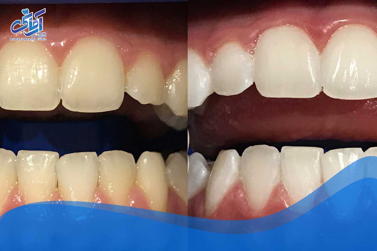 قبل و بعد سفید کردن سریع دندان
