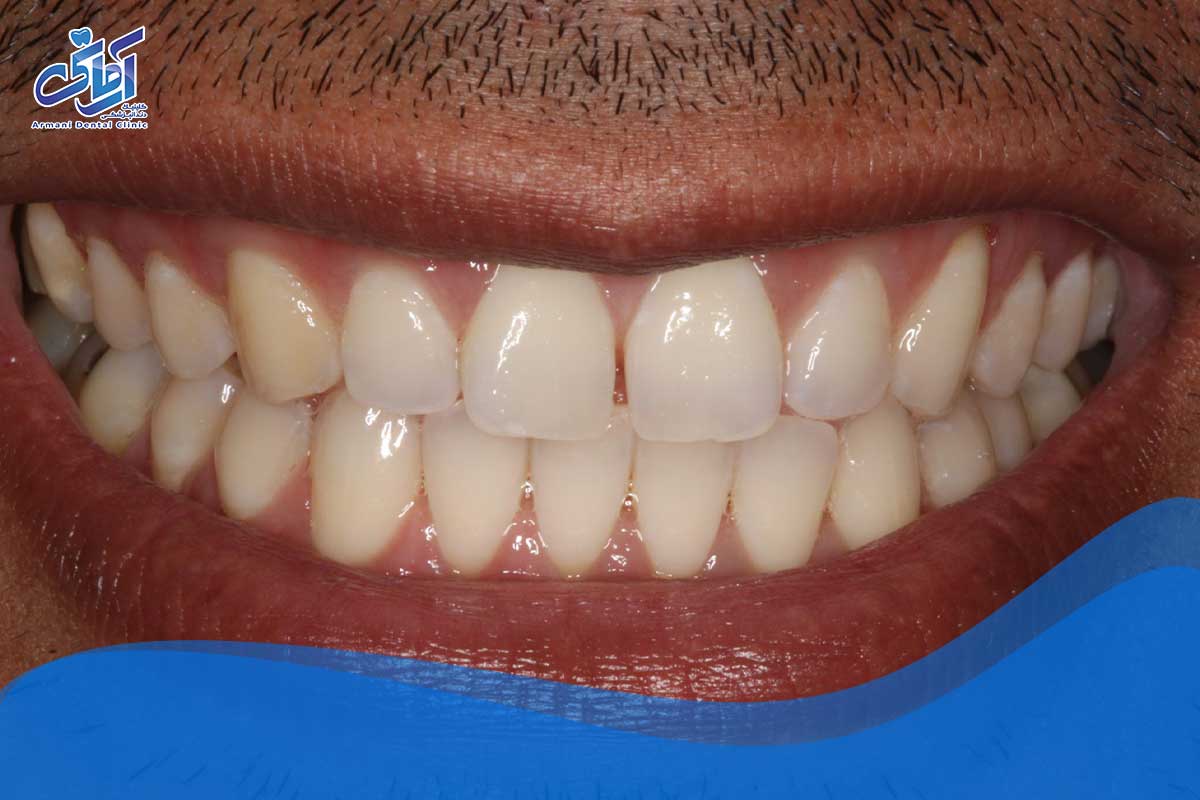 دیاستما ممکن است به دلایل مختلفی رخ دهد 