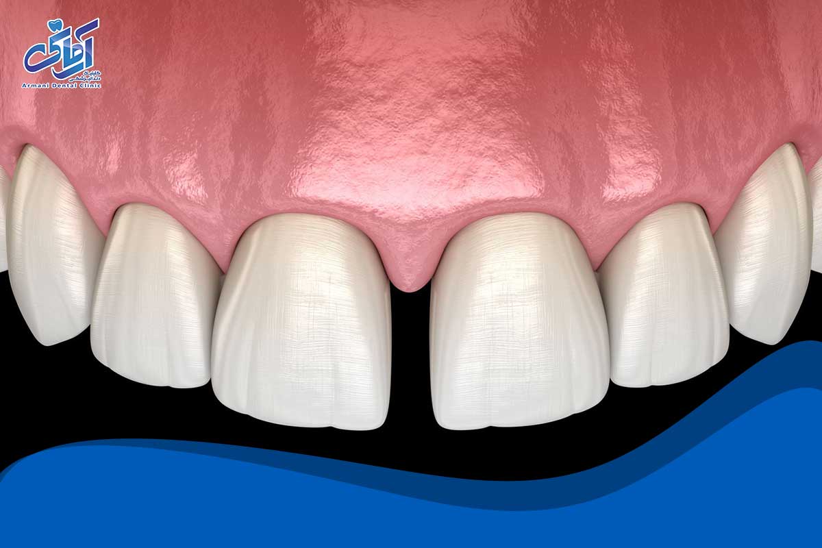 چه چیزی باعث ایجاد شکاف بین دندان‌ها می‌شود؟