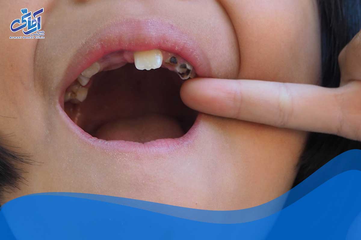 الگوبرداری از سلامت دهان و دندان در کودکان
