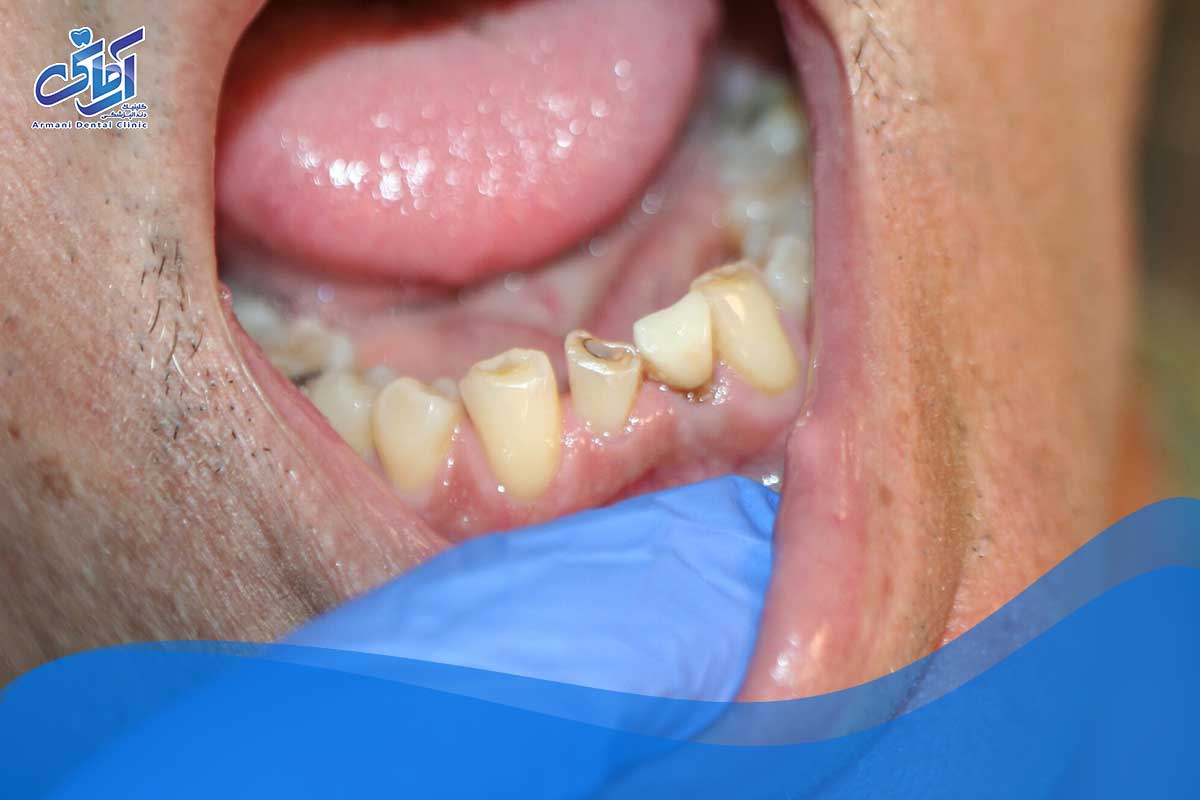 در صورت شکستن یا بریدگی دندان چه باید کرد؟