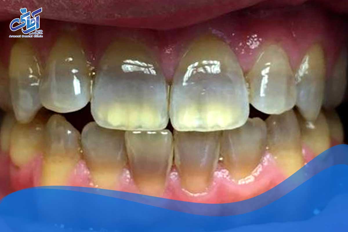 عکس تغییر رنگ لمینت دندان