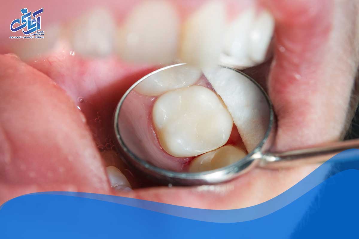 چگونه تا زمان مراجعه به دندانپزشک از دهان خود محافظت کنیم؟