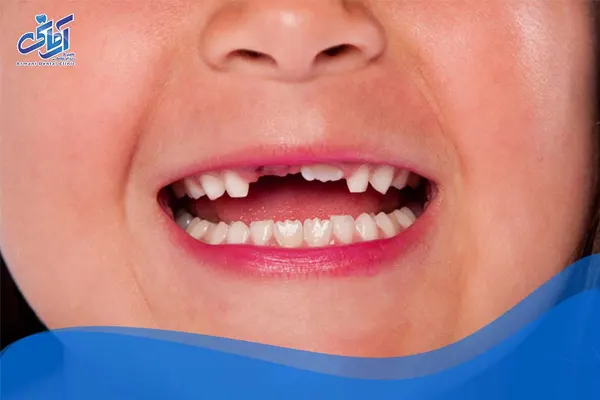 افتادن دندان شیری