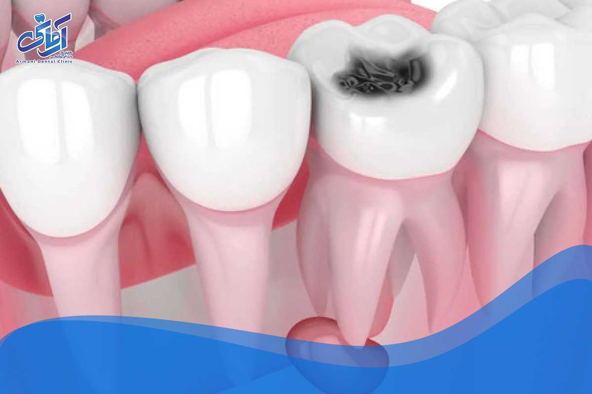 داروهایی که برای جلوگیری از پوسیدگی دندان استفاده می‌شود: