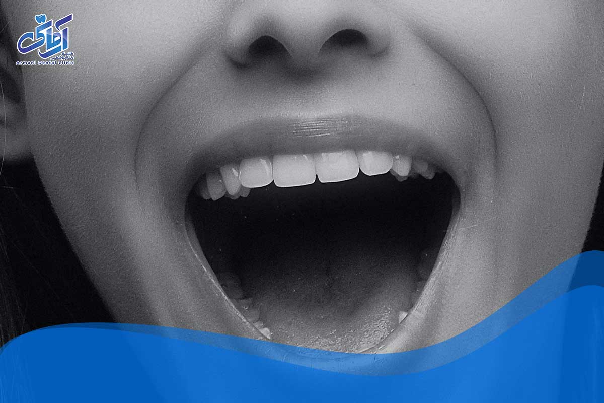 چگونه می توانیم از سندرم سوزش دهان جلوگیری کنیم؟