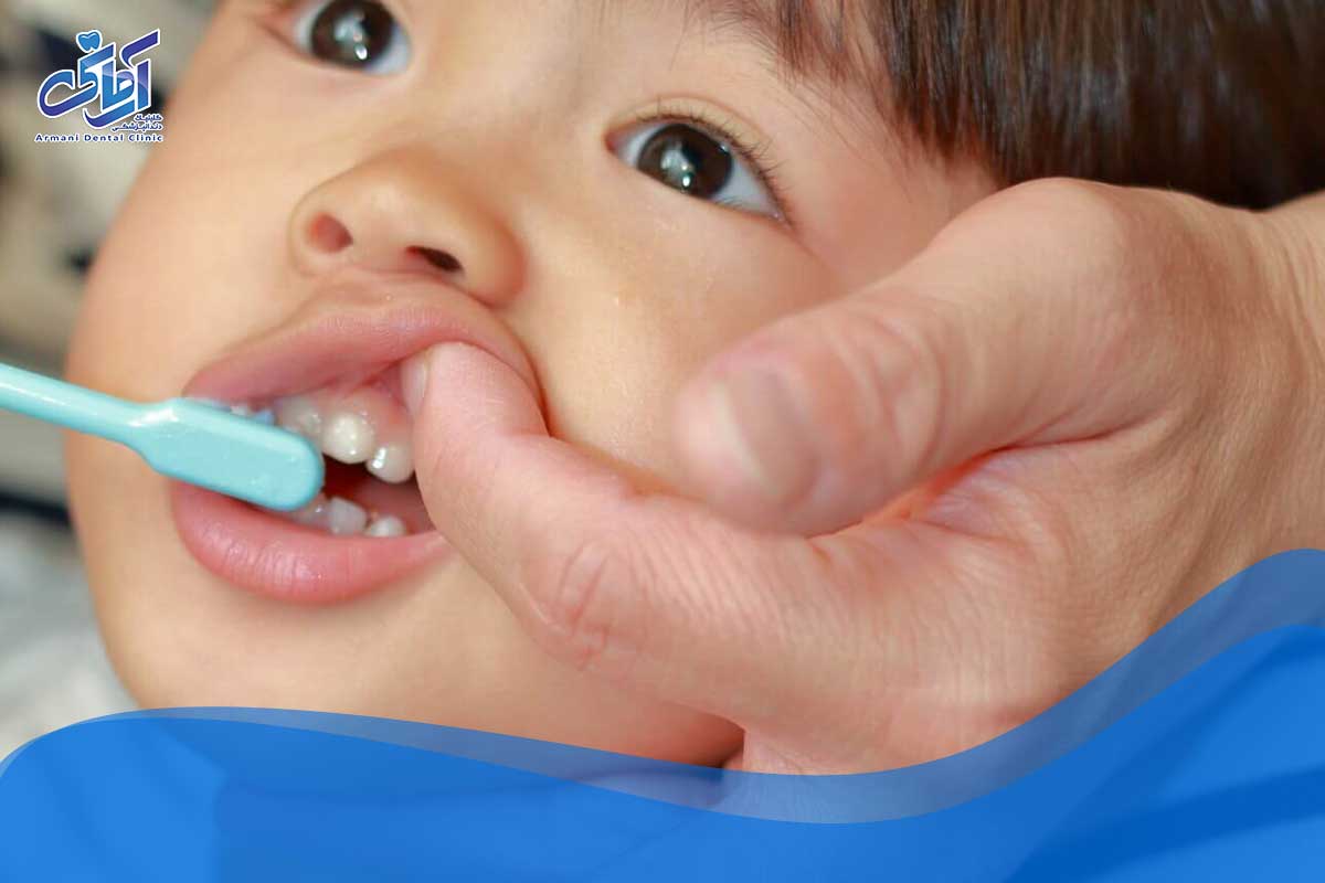پیشگیری از پوسیدگی دندان اطفال را در اولویت خانواده قرار دهید