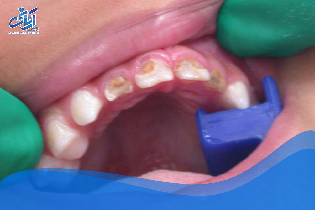 عکس پوسیدگی دندان اطفال