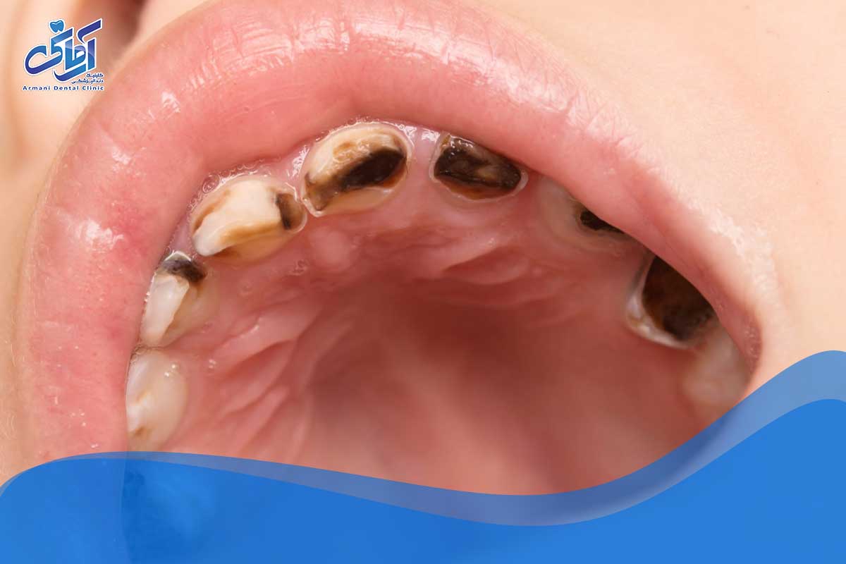 چند گام روزانه برای سالم نگه داشتن دندان های کودک