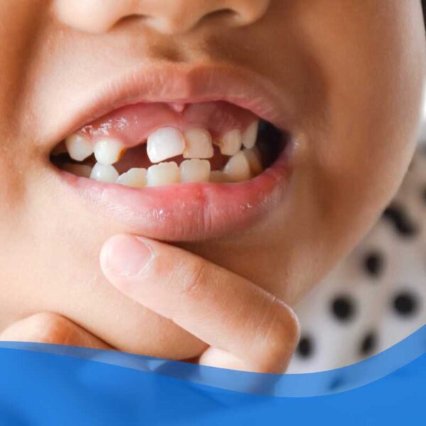 شکستگی دندان در کودکان