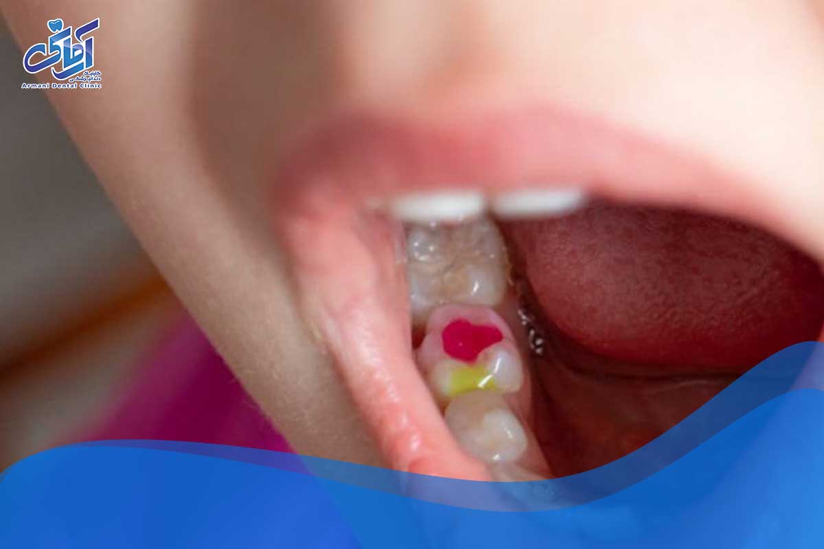 پیشگیری از پوسیدگی دندان: