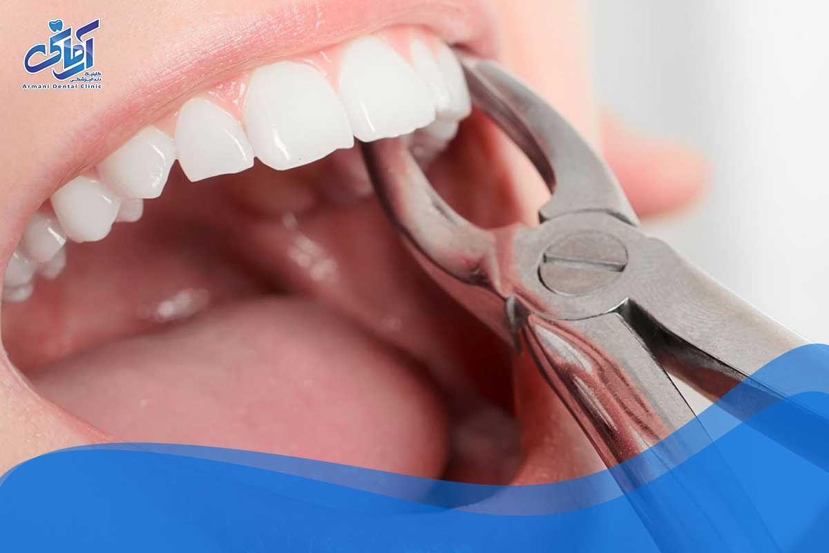 آیا کشیدن دندان عقل واجب است؟