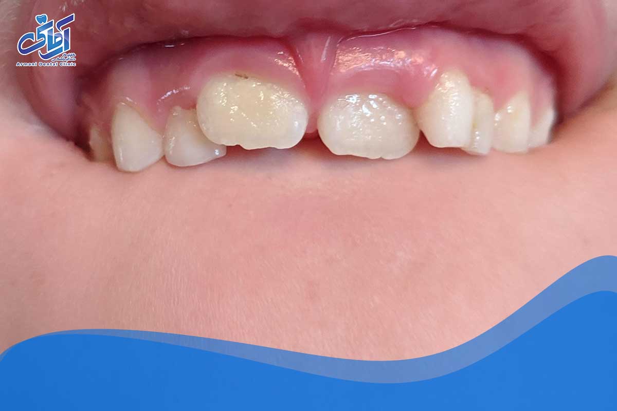 علل شکستگی دندان در کودکان چیست؟
