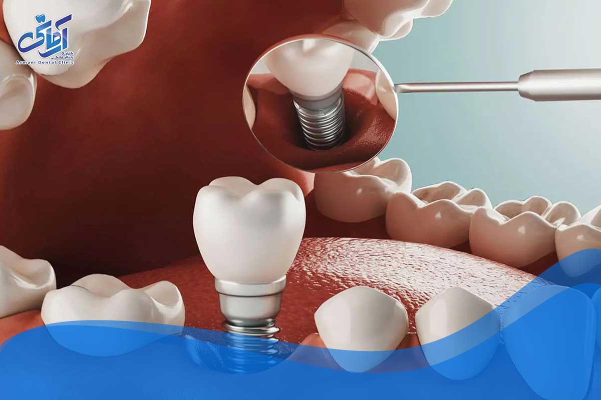مواد ایمپلنت دندان: تیتانیوم و آلیاژهای تیتانیوم