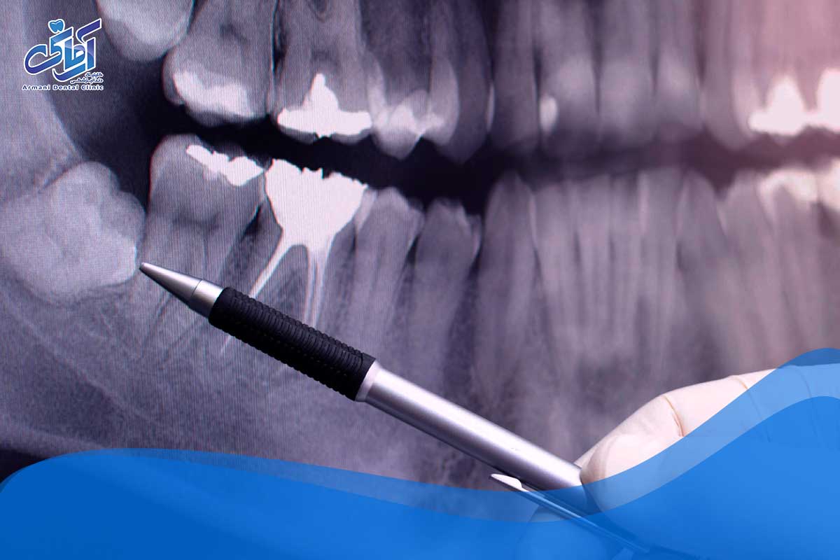 بیماری لثه و پوسیدگی دندان عقل