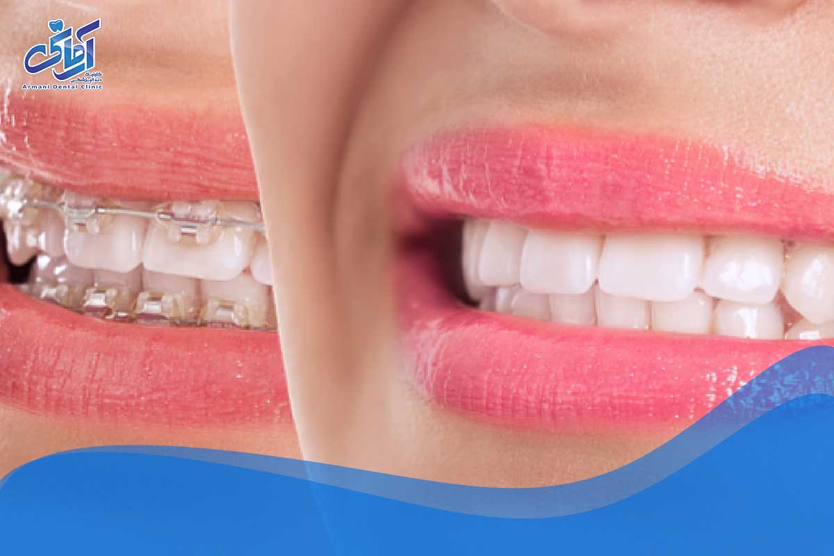 نحوه حرکت دندان ها در طول درمان ارتودنسی