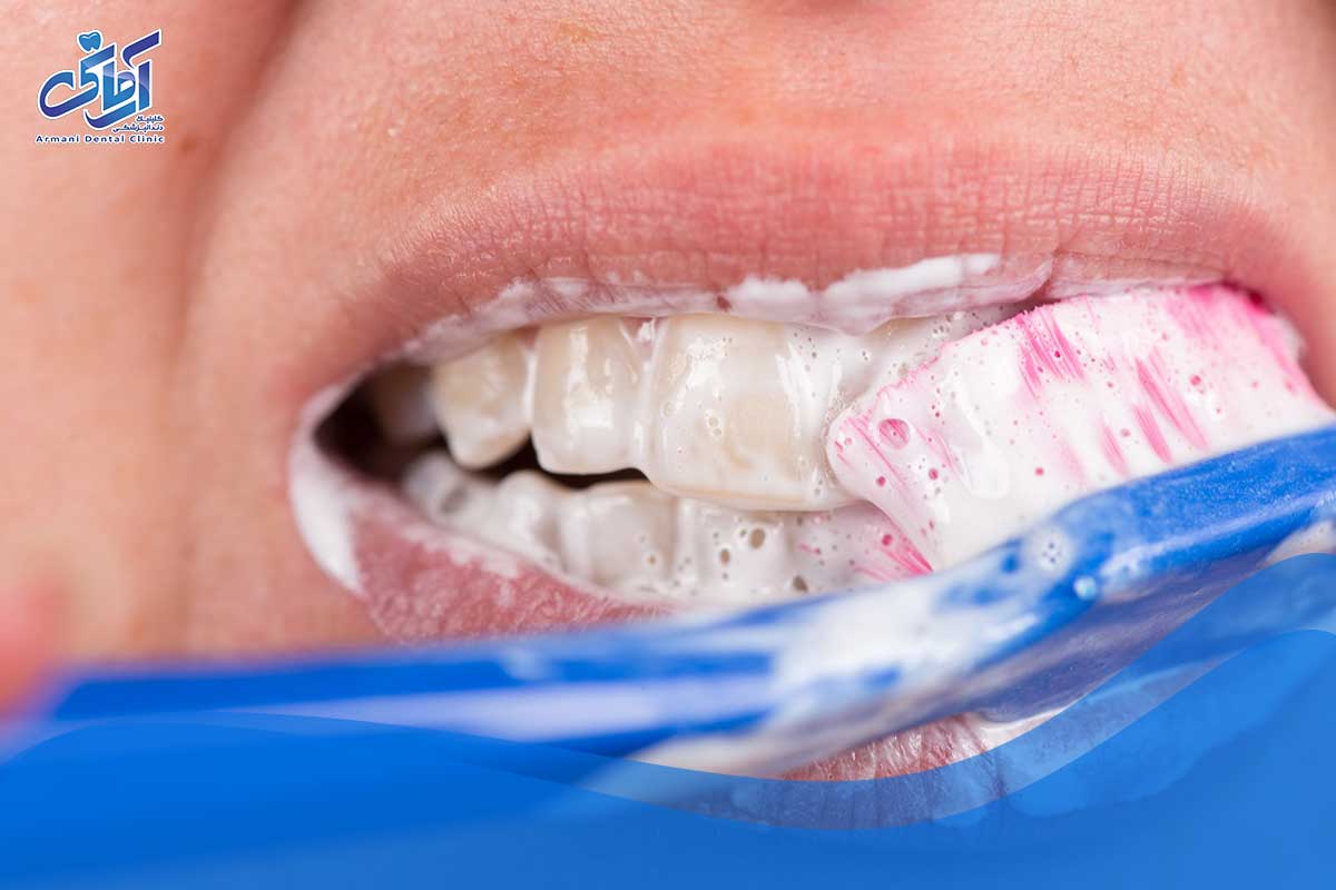 آیا سفید کردن دندان می تواند به مینای دندان آسیب برساند؟