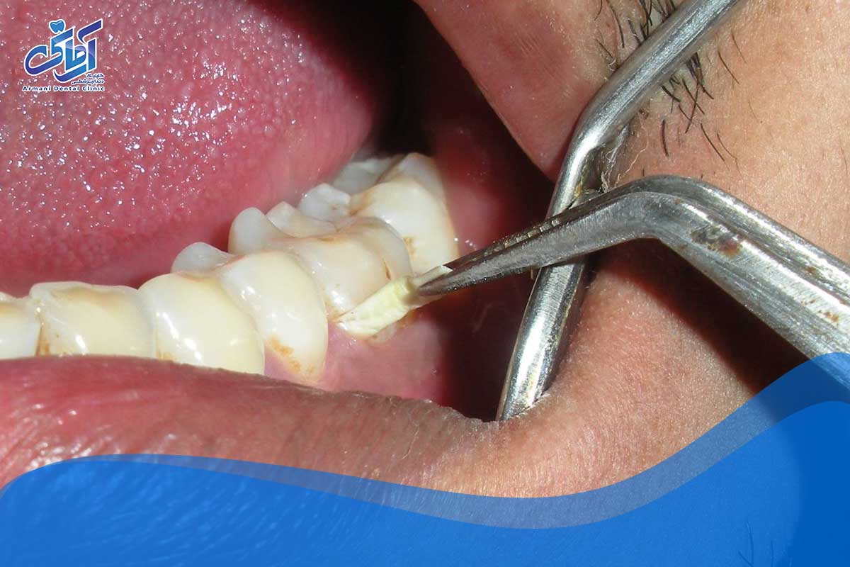 پیشگیری از دندان درد در شب