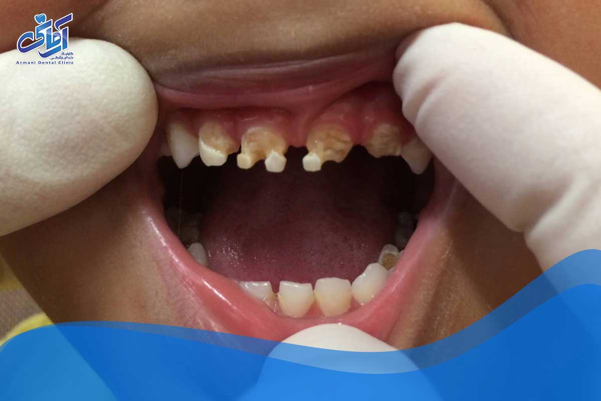 آیا شکر جدا از پوسیدگی باعث ایجاد بیماری های دندانی می شود؟