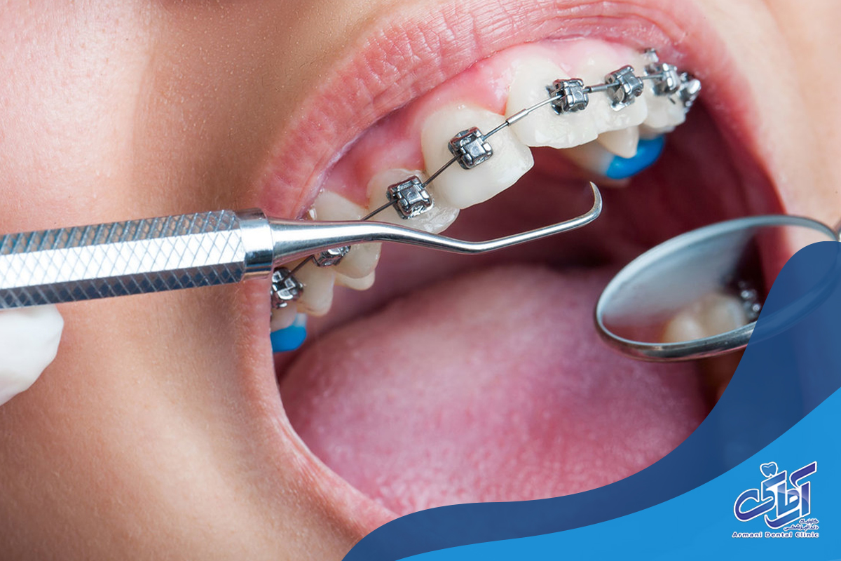 آیا شل شدن دندان در طول درمان ارتودنسی دائمی است؟