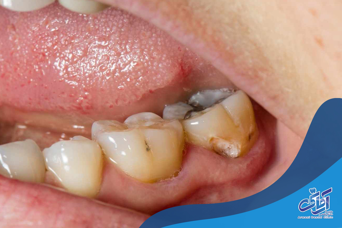 درمان پوسیدگی دندان در ارتودنسی