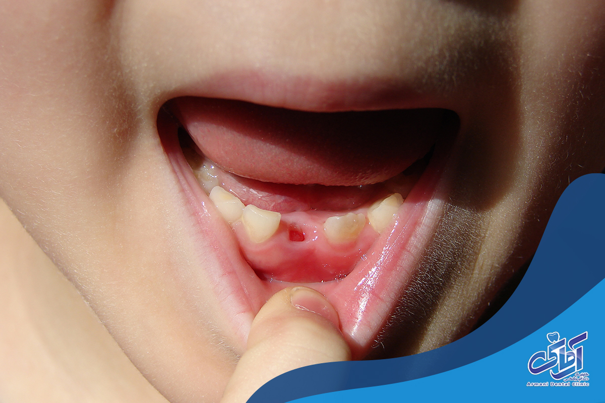وقتی دندان شیری کودک بیرون نمی آید چه باید کرد؟