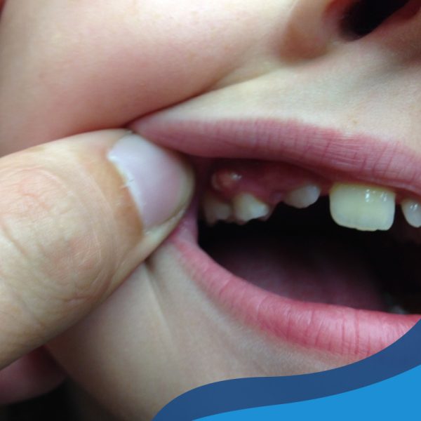 درمان سریع عفونت دندان کودکان در خانه 5 عفونت دندان کودکان