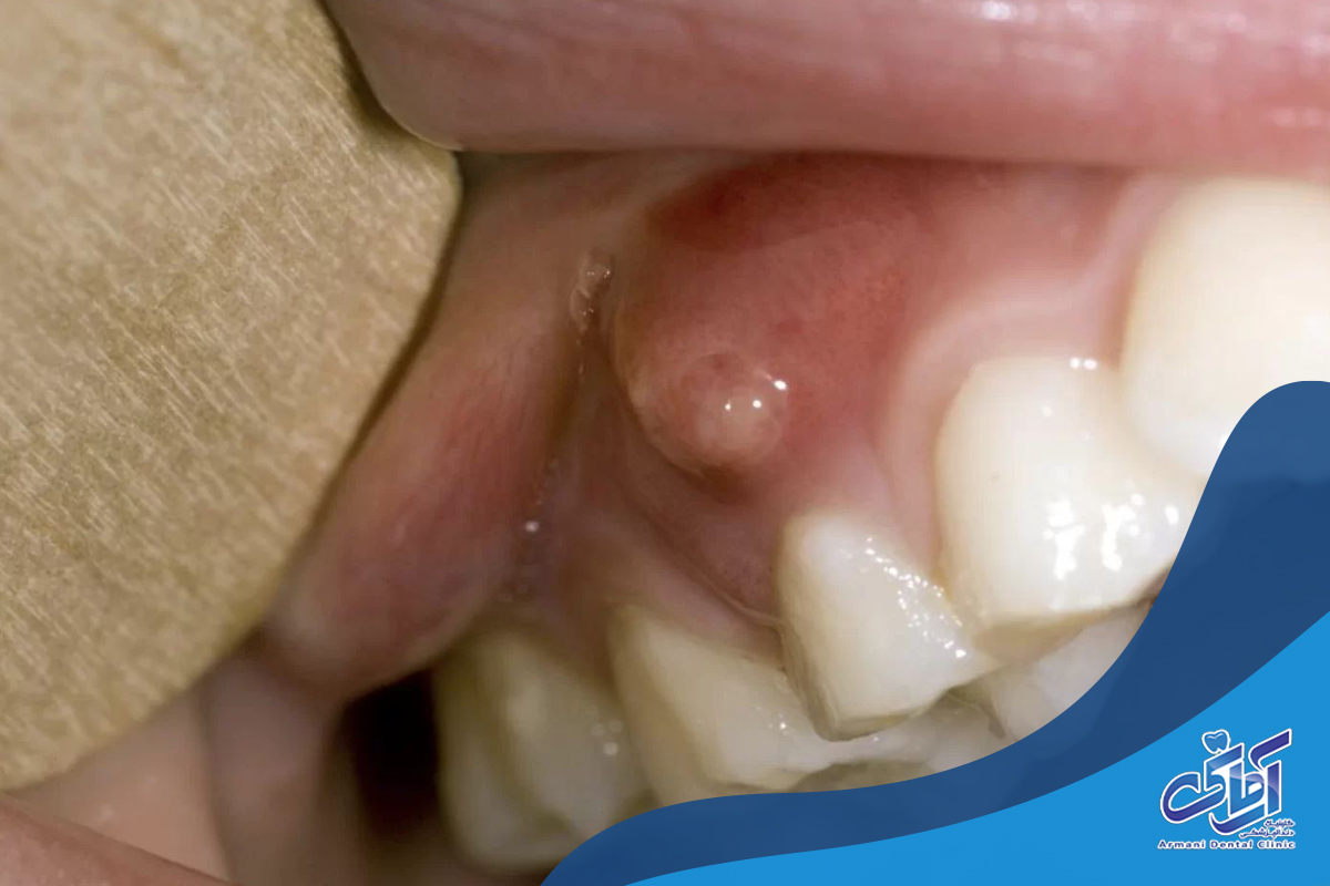 علت‌ها و دلایل عفونت و آبسه دندان
