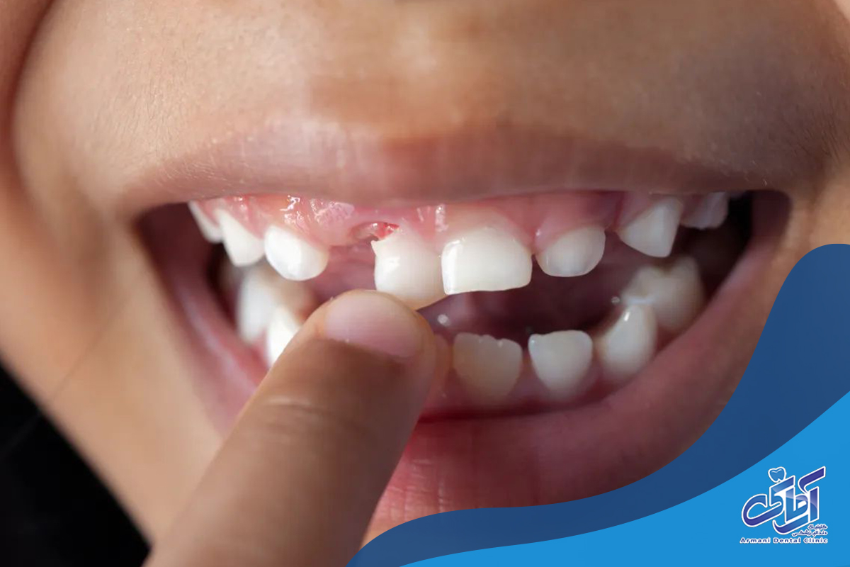 در صورت تاخیر در درآمدن یا افتادن دندان شیری چه کاری باید انجام دهید؟