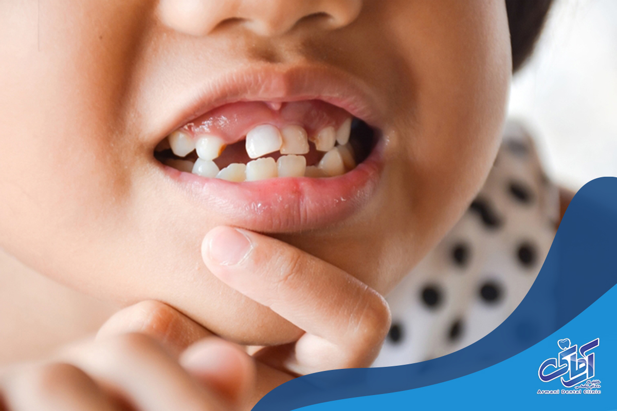 لق شدن دندان کودکان چه علتی دارد؟