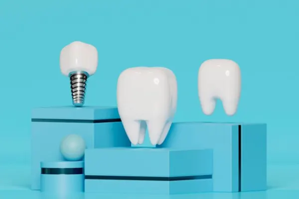 ایمپلنت دندان در شهریار ، بهترین کلینیک ایمپلنت دندان در شهریار 1 ایمپلنت