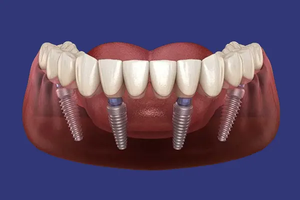 ایمپلنت کل فک