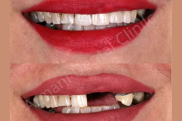 ایمپلنت دندان در دوران بارداری