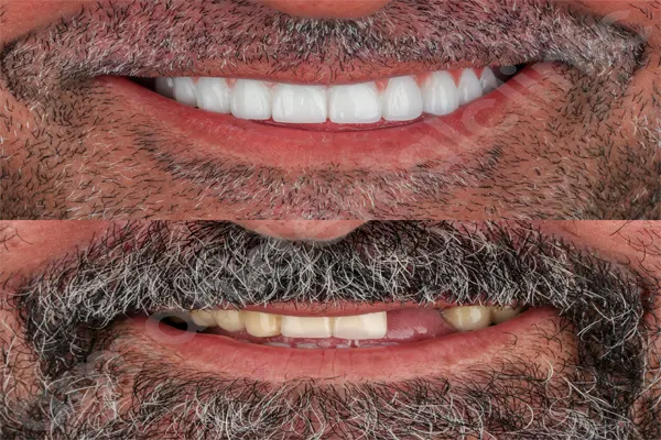 حرف زدن بعد از جراحی ایمپلنت