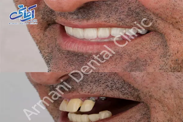 فیلم ایمپلنت دندان