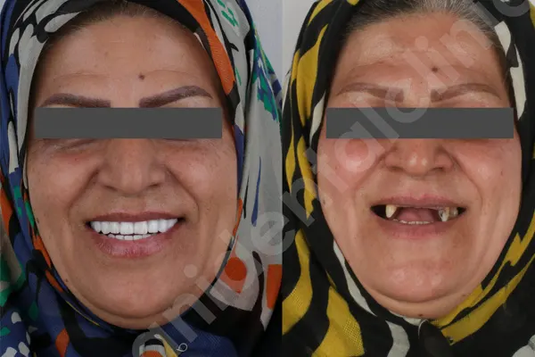 مراحل ایمپلنت دندان