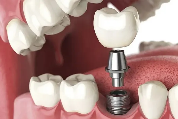 مراقبت های قبل ایمپلنت دندان 1 مراقبت های قبل ایمپلنت دندان