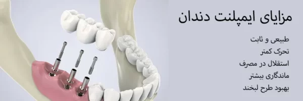 مزایای ایمپلنت دندان