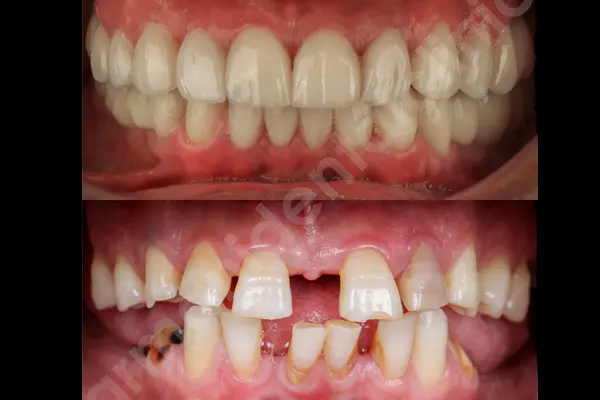 مزیت های ایمپلنت دندان