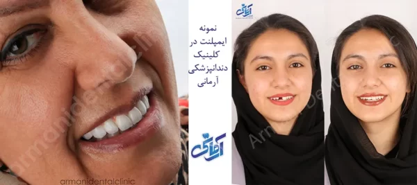 نمونه ایمپلنت زنان در کلینیک آرمانی