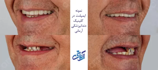 نمونه ایمپلنت کلینیک آرمانی